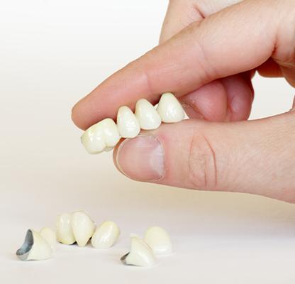 Dental Bridges Treatment | Calgary Family Dentist | Dental Station | Calgary, AB