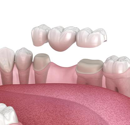 Dental Bridges Treatment | Calgary Family Dentist | Dental Station | Calgary, AB