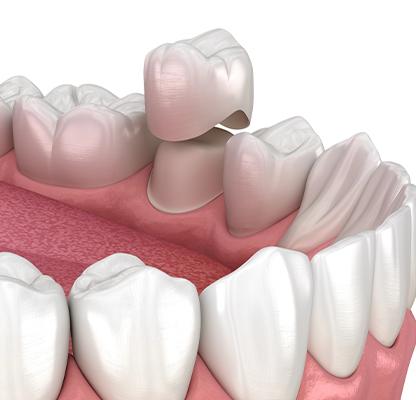Calgary Dental Crowns | Family Dentist | Dental Station | Calgary, AB