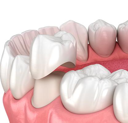 NW Calgary Dental Crowns | Family Dentist | Dental Station | Calgary, AB
