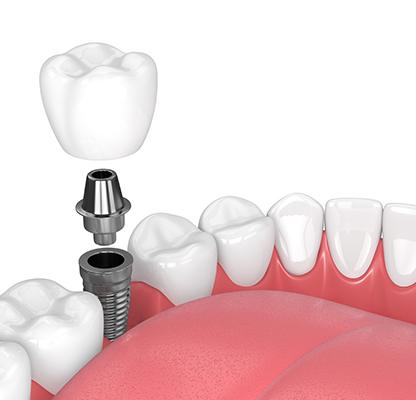 Calgary Dental Implants | Family Dentist | Dental Station | Calgary, AB
