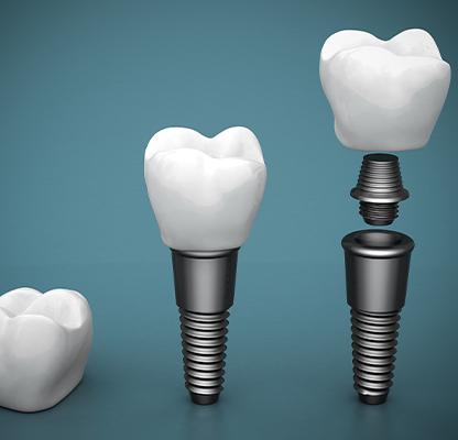 Dental Implants | Calgary Family Dentist | Dental Station | Calgary, AB