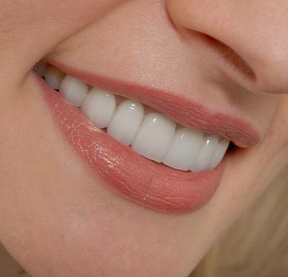 Porcelain Veneers | Calgary Family Dentist | Dental Station | Calgary, AB