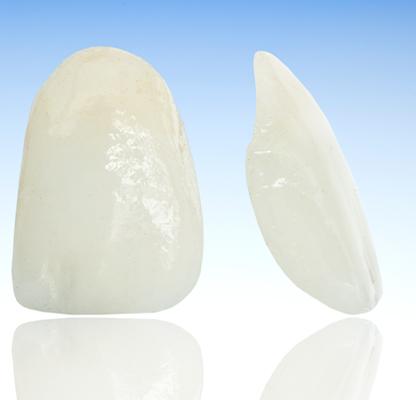 Porcelain Veneers | Calgary Family Dentist | Dental Station | Calgary, AB