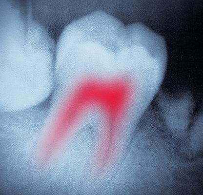 Calgary Root Canal Therapy | Family Dentist | Dental Station | Calgary, AB