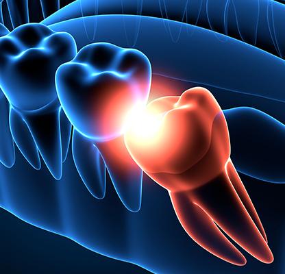 Wisdom Teeth Extractions | Dental Station | Calgary, AB