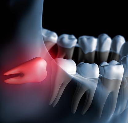 Calgary Wisdom Teeth Extractions | Dental Station | Calgary, AB
